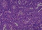 Thumbnail_Novus Biologicals Human Multi-tissue Tissue MicroArray (Cancer) Human Ovary