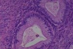 Thumbnail_Novus Biologicals Human Multi-tissue Tissue MicroArray (Cancer) Human Ovary