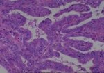 Thumbnail_Novus Biologicals Human Multi-tissue Tissue MicroArray (Cancer) Human Ovary