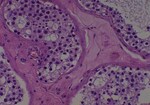 Thumbnail_Novus Biologicals Human Multi-tissue Tissue MicroArray (Cancer) Human Ovary