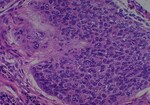Thumbnail_Novus Biologicals Human Multi-tissue Tissue MicroArray (Cancer) Human Ovary