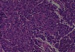 Thumbnail_Novus Biologicals Human Multi-tissue Tissue MicroArray (Cancer) Human Ovary