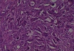 Thumbnail_Novus Biologicals Human Multi-tissue Tissue MicroArray (Cancer) Human Ovary