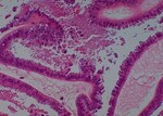Thumbnail_Novus Biologicals Human Multi-tissue Tissue MicroArray (Cancer) Human Ovary