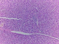 Novus Biologicals&trade;&nbsp;Liver Tissue Slides (Nodulous Hepatocellular Carcinoma)- Paraffin