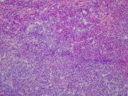 Novus Biologicals Lung Matched Primary Tumor and Metastatic Tumor Slides - Frozen 10 portaobjetos | Buy Online | Novus Biologicals&trade; | Fisher Scientific