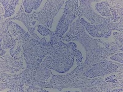 Novus Biologicals Lung Tissue Slides (Tumor)- Paraffin 5 portaobjetos | Buy Online | Novus Biologicals&trade; | Fisher Scientific