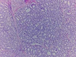 Novus Biologicals&trade;&nbsp;Prostate Tissue Slides (Tumor)- Paraffin