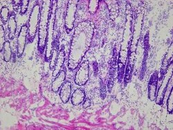 Novus Biologicals Rectum Matched Tumor and Normal Tissue Slides (Tumor)- Frozen 10 Slides | Buy Online | Novus Biologicals&trade; | Fisher Scientific