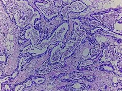 Novus Biologicals Stomach Tissue Slides (Adenocarcinoma)- Paraffin 5 Slides | Buy Online | Novus Biologicals&trade; | Fisher Scientific