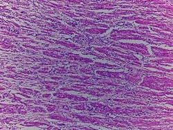 Novus Biologicals&trade;&nbsp;Stomach Tissue Slides (Signet Ring Cell Carcinoma)- Paraffin