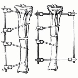 Med Vet International&nbsp;Large Fixation Type II Kit, Large IM Pin, 5/32” x 10” Rod, 10”L, J0371KBL, 1 Kit