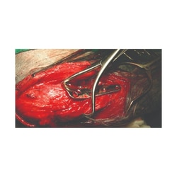 Med Vet International&nbsp;TPLO Wire Guide and Reduction Forcep, Left, 215mm, J1272A