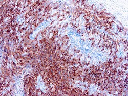 Diagnostic Biosystems MELANOMA PAN COCKTAIL, Quantity: Each of 1