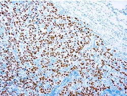 Diagnostic Biosystems&nbsp;SOX10 SOX10 (Melanoma Marker)