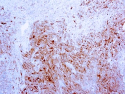 Diagnostic Biosystems&nbsp;MART-1/MELAN A MART-1/Melan-A, Melanoma Marker