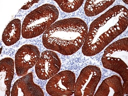 Biocare Medical, LLC MOC-31 Antibody - Predilute, 6.0 ml, Quantity: Each