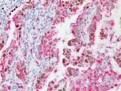 Biocare Medical, LLC TTF-1 + Napsin A, 6ml, Provides a High Sensitivity