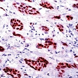 Progesterone Receptor Monoclonal Antibody (SP2), Invitrogen 500 &mu;L | Buy Online | Invitrogen | Fisher Scientific